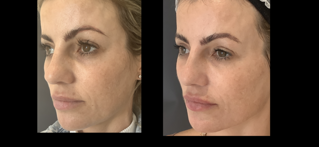 How Long Does Cheek Filler Last