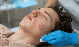 How to Calm a Rosacea Flare-Up
