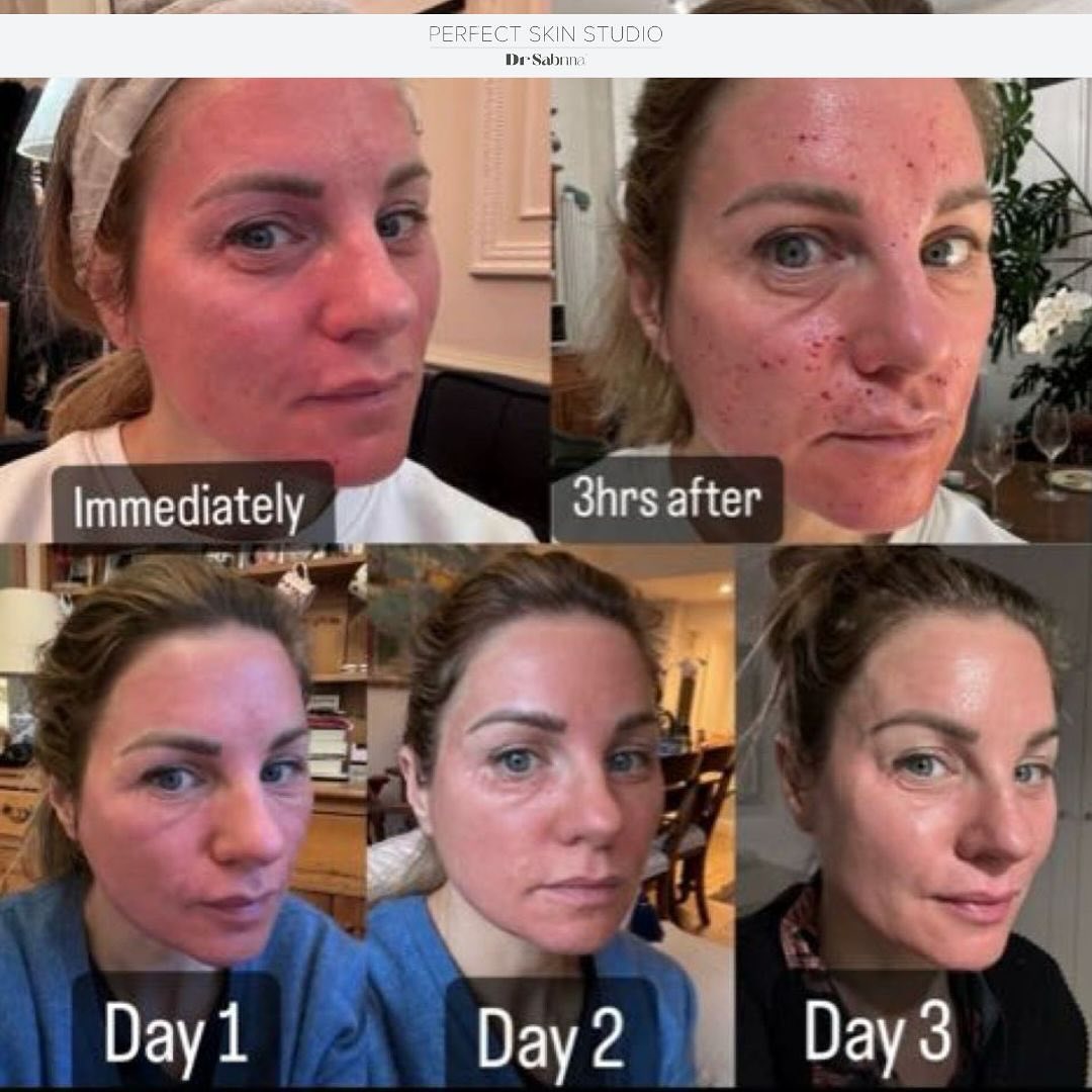 UltraClear Laser Before and After
