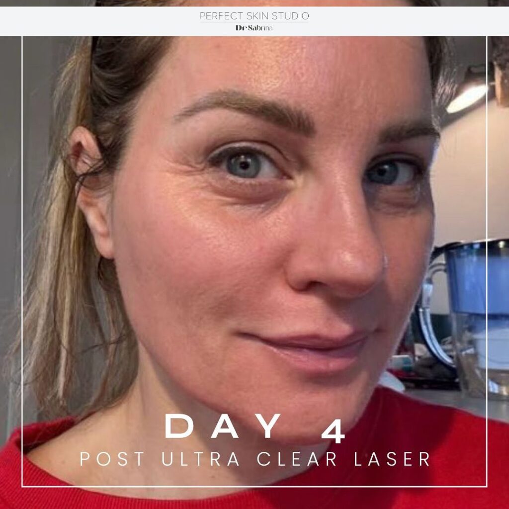 UltraClear Laser Before and After