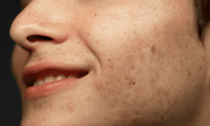 How to get rid of acne scars