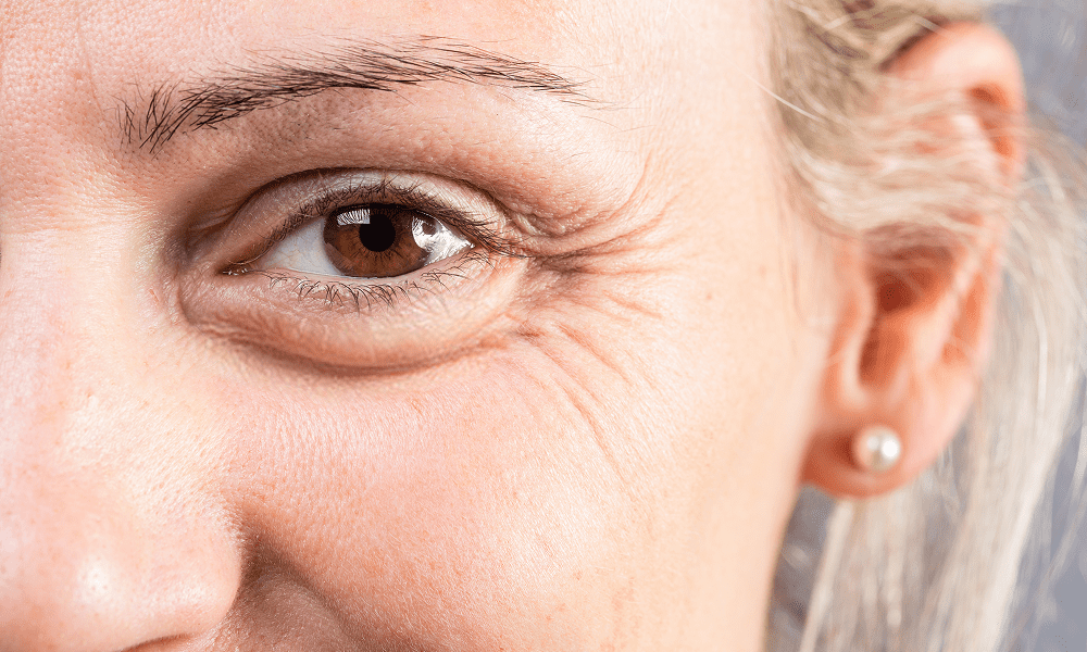 Treatment for Crow's Feet