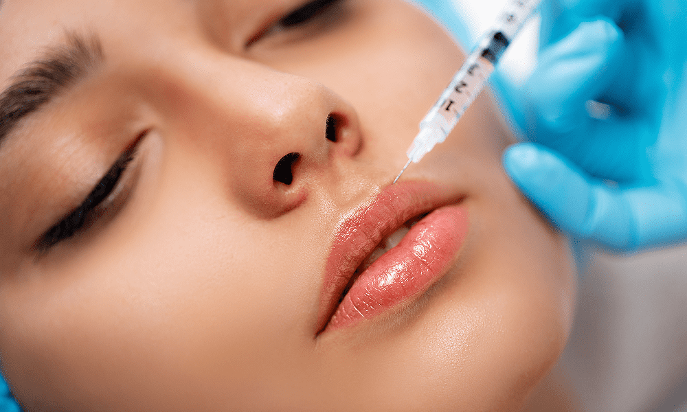 Fillers for Smile Lines