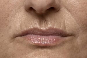 Lip lines