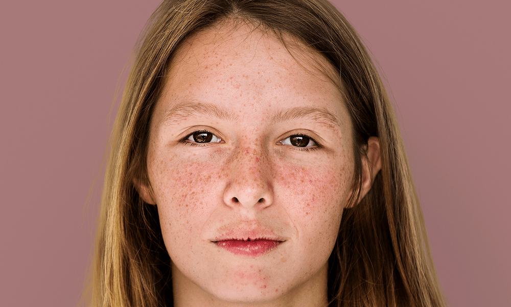 Dark Patches on Face