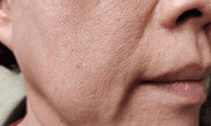 Treatment for Marionette Lines